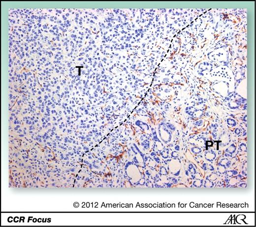 Figure 2. Murine PDA is characterized by hypovasularity. In this example of CD31 immunohistochemistry, the dotted line denotes the boundary between tumor (T) and peritumoral diseased pancreas (PT; ×20 magnification).