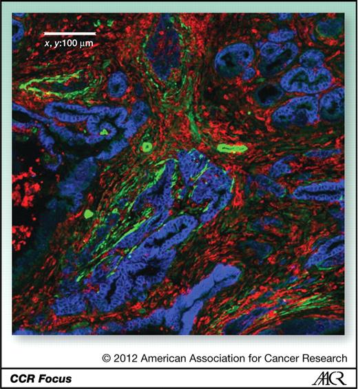 Figure 3. Prominent immune cell infiltration exists in mouse PDA. This immunofluorescence staining illustrates the abundance of immune cells marked by CD45 expression (red) between neoplastic glandular structures (stained for EpCam in blue) and α-SMA positive stromal fibroblasts and perivascular cells that likely represent pericytes (green; ×20 magnification).