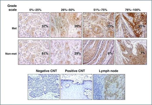 Figure 1. Integrin β1 expression pattern in HNSCC tissues from patients with and without metastasis. IHC analysis of integrin β1 in HNSCC samples shows membrane and cytoplasmic expression patterns. Of the patients without metastasis, 61% had 0% to 25% positive staining, 29% had 26% to 50% positive staining, 8% had 51% to 75% positive staining, and only 1% of patients had 76% to 100% positive staining, whereas of the patients with metastasis, 37% had 0% to 25% positive staining, 20% had 25% to 50% positive staining, 23% had 51% to 75% positive staining, and 21% of patients had 76% to 100% positive staining. Tissue stained with IgG only and normal epithelium staining was used as a negative and positive control, respectively. Metastatic lymph node shows a similar staining as its primary counterpart (magnification, ×200).