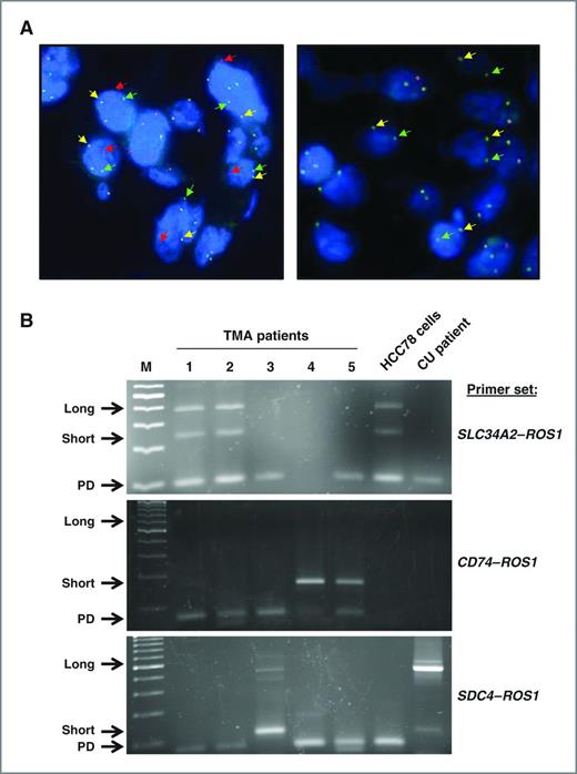 Identifying and Targeting ROS1 Gene Fusions in Non–Small Cell Lung ...