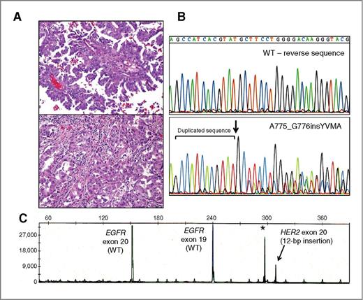 Figure 3. Representative case harboring the most common ERBB2 mutation, A775_G776insYVMA. A, morphologically, this tumor showed a mixed phenotype with papillary, micropapillary, and solid components. B, bottom tracing, standard sequencing (reverse) shows further characterization of the mutation as A775_G776insYVMA (2324_2325ins12 [ATACGTGATGGC]). The arrow marks the beginning of the insertion sequence. Top tracing, the reverse WT sequence for comparison. C, ABI tracing of the sizing assay shows a heterozygous 12 bp insertion (arrow); asterisk marks the adjacent wild-type peak. This case was concurrently tested for indels in exon 19 and 20 of EGFR using a multiplex assay and illustrates the mutually exclusive nature of these mutations.