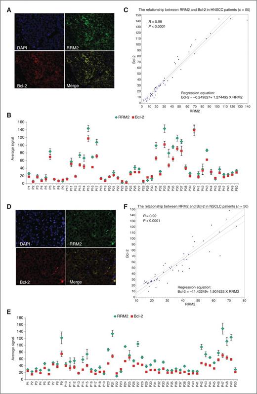 Figure 7. RRM2 and Bcl-2 proteins colocalize, and their expression is positively correlated in tumor tissues from patients with HNSCC and NSCLC. A and D, staining of RRM2 and Bcl-2 in paraffin-embedded formalin-fixed HNSCC (A) and NSCLC (D) tissue sections using primary antibodies with QD-secondary antibody conjugates. A representative QD-image is shown (×400 magnification). B and E, quantification of QD signals. Average signals of RRM2 and Bcl-2 expression in each HNSCC (B) and NSCLC (E) patient sample were plotted. C and F, Spearman correlation coefficient was estimated between Bcl-2 and RRM2 levels in HNSCC (C) and NSCLC (F) tumors. A linear regression was used to plot their relationship with 95% confidence interval bound.