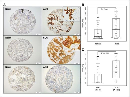 Figure 1. SLC1A5 is differentially expressed in NSCLC tumors and located at the level of the cytoplasmic membrane. A, representative images of IHC staining for SLC1A5 protein in a TMA constructed from archival lung tissue sections collected from 98 patients with lung cancer representing the main lung cancer histologic subtypes. Left, 3 representative photomicrographs at × 100 magnification of sections of normal lung tissue from patients with lung cancer, which stained negative for SLC1A5. Right, representative photomicrographs at × 100 magnification of lung cancer sections from patients with stage IIA ADC and IIB SCC. A zoomed in × 200 magnification of a small area of the same sections in the top right corner shows membranous staining pattern of cancer cells. A section of ADC that did not stain for SLC1A5 is also represented here. B, a box plot of SLCA15 protein IHC index (intensity × % tumor cells) shows significantly higher index of staining (P < 0.001) of tumors in males (N = 56) than in females (N = 42). C, a box plot of SLCA15 protein IHC index shows significantly increased IHC staining index in SCC compared with ADC (P < 0.001). A detailed summary of our IHC analysis is provided in Table 1.