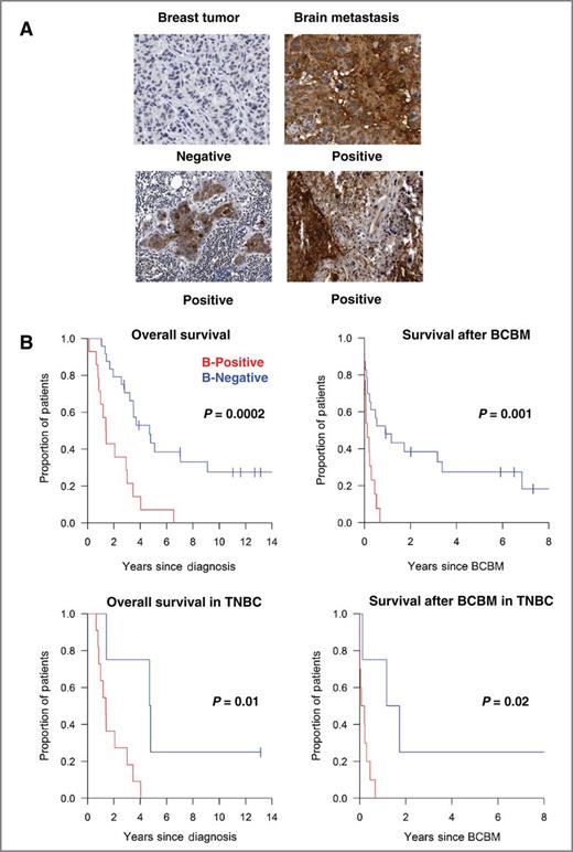 αB-Crystallin: A Novel Regulator of Breast Cancer Metastasis to the ...