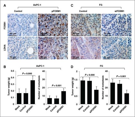 Figure 5. Influence of FOXM1–LDHA signaling on pancreatic cancer cell growth and metastasis in vivo. A to D, AsPC-1 cells with FOXM1 overexpression (A and B) or FG cells with knockdown of FOXM1 expression (C and D) were injected subcutaneously into the right scapular region in nude mice (1 × 106/mouse, n = 5) or intravenously into the ileocolic vein in nude mice (1 × 106/mouse, n = 5). The tumor-bearing mice were killed when they became moribund or on day 35 (subcutaneous) or day 21 (intravenous injection). Immunohistochemical staining of subcutaneous tumor specimens with specific anti-FOXM1 and anti-LDHA antibodies was performed. Shown are representative photographs of the expression of FOXM1 and LDHA protein in AsPC-1 (A) and FG (C) cells, the weights of the tumors (B and D, left), and the numbers of liver surface metastases (B and D, right).