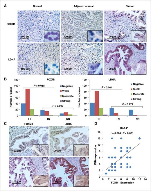 Figure 6. Concomitant expression of FOXM1 and LDHA in pancreatic tumors. Pancreatic tumor specimens in TMA and TMA-P were immunostained with specific anti-FOXM1 and anti-LDHA antibodies. A, representative images of FOXM1 and LDHA expression in normal pancreatic tissue, normal tumor-adjacent pancreatic tissue, and pancreatic tumor specimens (magnification, ×200). B, FOXM1 and LDHA expression in TMA-P. The expression levels were significantly higher in tumor (TT) than normal tumor-adjacent tissue (TN) and normal tissue (NN) specimens, whereas the expression of FOXM1 and LDHA did not differ between TN and NN. LDHA expression was associated with FOXM1 expression. C, representative photographs of negative (top two plots) and positive (bottom two plots) FOXM1 and LDHA staining in pancreatic tumor specimens. D, direct correlation between FOXM1 expression and LDHA expression in TMA-P (n = 154; Pearson correlation coefficient, r = 0.674; P < 0.001). Some of the dots on the graph represent more than one specimen (overlapping scores).