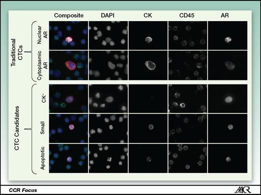 Figure 2. Traditional and novel CTC candidates. The top two panels demonstrate “traditional” CTCs (CK+, CD45−, intact and morphologically distinct DAPI) with AR expression and AR subcellular localization using the Epic CTC platform. In addition, novel CTC candidates, including CK− CTCs (CK−, CD45−, intact and morphologically distinct DAPI), small CTCs [CK+, CD45−, intact DAPI but morphologically similar to white blood cells (WBC)], and apoptotic CTCs (CK+, CD45−, fragmented and morphologically distinct DAPI) may also be identified (bottom three panels). All CTC subpopulations can be characterized for protein expression and subcellular localization such as AR. Images courtesy of Ryan Dittamore, Epic Sciences, Inc.