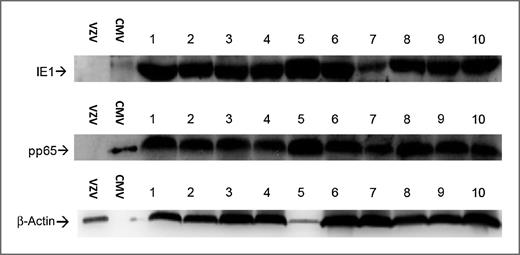 Figure 1. Detection of CMV proteins in primary GBM. Single-cell digests were prepared from deidentified newly diagnosed GBM specimens, washed with PBS, and lysates prepared in the presence of proteinase inhibitors. Western blot (WB) analysis was performed using CMV IE1-specific and pp65-specific mAbs on GBM lysates (20 μg per lane). CMV- and VZV-infected fibroblast lysates were used as positive and negative control samples respectively (1 μg per lane). Figure depicts 10 GBM specimens positive for CMV proteins IE1 and pp65. Normal brain lysates obtained from autopsy specimens were negative for detection of CMV proteins (0/5, data not shown).