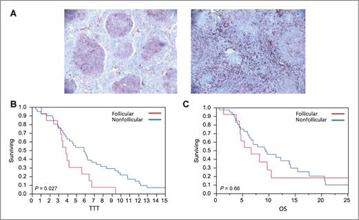 Figure 1. The CD14+ cells pattern of expression and TTT. A, the follicular and nonfollicular pattern of CD14+ staining. B, CD14+ cells localized to the follicle had a shorter TTT compared with those that were not localized to the follicle (2.8 vs. 5.9 years, P = 0.27). C, follicular CD14+ cells were not associated with improvement in OS (P = 0.66).