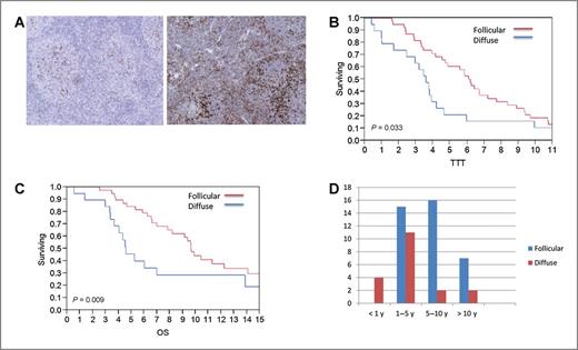 Figure 2. The PD1+ cell pattern and TTT and OS. A, the follicular and diffuse pattern of PD1+ cell expression. The follicular pattern of PD1+ cells is associated with prolonged TTT (B; 6.1 vs. 3.6 years, P = 0.03) and OS (C; 9.7 vs. 4.6 years, P = 0.009) compared with the diffuse pattern. D, all patients with early transformation (<1 year) had diffuse staining of PD1+ cells compared with the follicular pattern predominating amongst late transformation (>5 years).