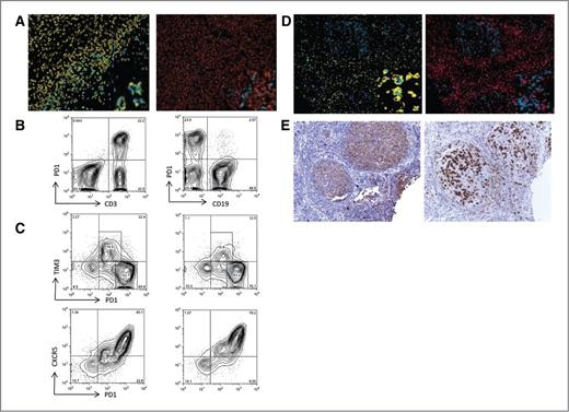 Figure 3. PD1+ cells coexpression. A, multicolor IHC with magnified insets of CD3 (yellow) and PD1 (blue) demonstrating colocalization of staining, whereas CD 20 (orange) is not colocalized to PD1+ cells. B, flow cytometry demonstrates primary coexpression with PD 1 and CD3 compared with PD1 and CD19 (n = 5). C, flow cytometry of patient samples illustrates PD1+ cells coexpress CXCR5 and TIM3 (n = 3). D, multicolor IHC with magnified insets confirms that PD1+ (blue) cells in follicle are positive CD3 (pink) and negative for TIM3 (yellow), whereas PD1 cells outside follicle are positive for TIM3. E, CXCR5 and PD1 both localize to the follicle, suggesting coexpression.