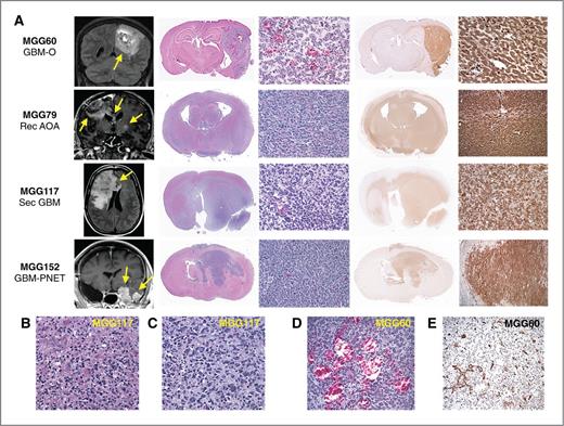 Figure 1. Mouse orthotopic xenografts generated from patient IDH1 R132H-mutant gliomas. A, rows: individual IDH1-mutant glioma orthotopic (intracerebral) xenografts. Columns left to right: xenograft line and patient tumor histology; representative patient MRI (yellow arrows highlight areas of tumor); gross xenograft histologic hematoxylin and eosin (HE) section; microscopic xenograft HE section; gross xenograft IHC section stained with IDH1 R132H mutant-specific antibody (brown); microscopic xenograft anti-IDH1 R132H (brown) IHC. Predominantly nodular (MGG60, 152) and infiltrative (MGG79, 117) growth patterns of xenografts are in accordance with the respective human tumors as demonstrated by MRI. B and C, microscopic section of MGG117 primary tumor (B) and orthotopic xenograft (C) showing marked cellular heterogeneity and nuclear pleomorphism in both sections. D and E, MGG60 xenograft demonstrating tumor angiogenesis by (D) HE and (E) endothelium-specific anti-CD31 antibody IHC. GBM-O, GBM with oligodendroglial component; Rec AOA, recurrent anaplastic oligoastrocytoma; Sec GBM, secondary GBM; GBM-PNET, GBM with primitive neuroectodermal tumor component.