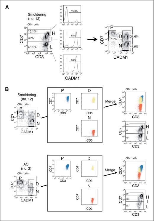 Figure 1. CADM1 versus CD7 plot for CD4+ cells from HTLV-I–infected blood samples analyzed by flow cytometry. A, representative flow-cytometric analysis of a patient with smoldering-type ATL. Three subpopulations (H, I, and L) were observed in the CD3 versus CD7 plot for CD4+ cells (left). Expression of CADM1 in each subpopulation is shown (middle). The right-hand panel shows how the CADM1 versus CD7 plot for CD4+ cells was constructed. B, the P, D, and N subpopulations in the CADM1 versus CD7 plot correspond to the H, I, and L subpopulations in the CD3 versus CD7 plot. Blue, yellow, and red dots, respectively, indicate the P, D, and N subpopulations in the CADM1 versus CD7 plot, and are redrawn in the CD3 versus CD7 plot. Two representative cases are shown. In the upper case, the P and D subpopulations in the CADM1 versus CD7 plot are partly intermingled in the CD3 versus CD7 plot. Unlike the CD3 versus CD7 plot, the CADM1 versus CD7 plot clearly distinguishes three subpopulations.