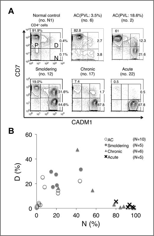 Figure 3. Proportion of each subpopulation in the CADM1 versus CD7 plots for asymptomatic HTLV-I carriers (asymptomatic carriers) and ATLs of various clinical subtypes. A, data of representative cases are shown. B, a two-dimensional plot of all analyzed samples showing the percentages of the D and N subpopulations.