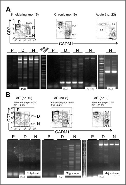 Figure 4. Clonality of subpopulations in the CADM1 versus CD7 plot analyzed by inverse long PCR. FACS-sorted cells (P, D, and N) were subjected to inverse long PCR. The black bar indicates duplicate data. Flow-cytometric profiles and clinical data are also presented. A, representative cases of smoldering-, chronic-, and acute-type ATL are shown. B, representative cases of asymptomatic carriers are shown.