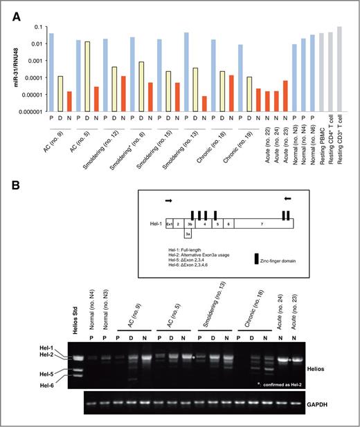 Figure 6. Gene expression pattern in the CADM1/CD7 subpopulation. A, miR-31 expression levels quantified by TaqMan-based real-time PCR. Total RNAs derived from each subpopulation were isolated and analyzed by RT-real-time PCR. RNU48 levels were also measured as an internal normalizer. *Smoldering (no. 8), this patient was considered to be at the asymptomatic carrier/smoldering borderline, because the proportion of abnormal lymphocytes fluctuated around 5%. On the day of sampling, the patient's hemogram showed 6.5% abnormal lymphocytes. B, expression analysis of Helios transcript variants in the subpopulations of normal controls (n = 2), asymptomatic carriers (n = 2), and ATLs (smoldering-type ATL, n = 1; chronic-type ATL, n = 1; acute-type ATL, n = 2). Comparisons of transcript variants among the P, D, and N subpopulations were performed by RT-PCR using primer sets specific for full-length Helios cDNA (top). The primer locations for Helios PCR are indicated by arrows in the schematic representation of Hel-1. The amplified cDNA (asterisk) was confirmed to be the Hel-2 variant. The Helios standard (left lane), a mixture of cDNA fragments of Hel-1, Hel-2, Hel-5, and Hel-6, was used as a size indicator for each transcript variant. The glyceraldehyde-3-phosphate dehydrogenase (gapdh) mRNA was analyzed as an internal control (bottom).