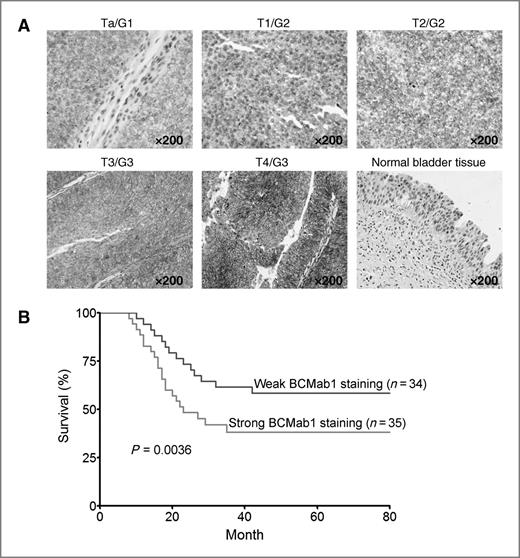 Figure 2. Expression of the BCMab1 epitope is consistent with clinical severity and prognosis of patients with bladder cancer. A, the expression level of the BCMab1 epitope is in agreement with clinical severity. Serial sections of bladder cancer biopsies were stained with BCMab1 by immunohistochemistry analysis. Normal bladder biopsy from a healthy person was not stained with BCMab1. B, relationship between the expressions of BCMab1 epitope and clinicopathologic features in radical-cystectomy patients. The patients with high expressions of the BCMab1 epitope had significantly worse prognosis than those with low expressions of the BCMab1 epitope (P = 0.0036); n, patient number.