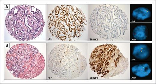 Figure 1. Immunohistochemical staining for ERG and SPINK1 as well as FISH for ERG rearrangement and PTEN deletion. A, shows a prostatic adenocarcinoma that demonstrates positive ERG immunostaining and a corresponding ERG rearrangement by FISH. The tumor is negative for SPINK1 overexpression and shows a hemizygous deletion of PTEN. B, shows a prostatic adenocarcinoma that demonstrates negative ERG immunostaining and no ERG rearrangement by FISH. The tumor shows SPINK1 overexpression and no deletion of PTEN by FISH.