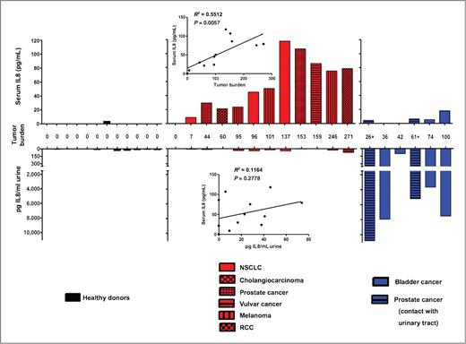 Figure 5. Serum and urine IL8 in patients with solid cancer, healthy volunteers, and urogenital tumors. Serum (top) and urine (bottom) IL8 concentrations were assessed in healthy donors (n = 12) and patients with cancer (n = 18) suffering carcinomas of the indicated color-coded histologic origins. Numbers between graphs depict tumor size as the sum of longest lesion diameters of each individual. Patients represented in the right panels were CT scan documented to host tumors in contact with the urinary tract (bladder or urethra) at the time of sample collection. Top inset, relation between tumor burden magnitude and serum IL8 levels. Bottom inset, the relation between urine and serum IL8 levels in patients with cancer.
