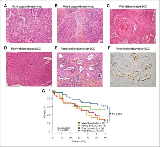 Figure 1. Pathology review. A, basaloid carcinoma: tumor cells are small, monomorphic, cuboidal, or fusiform, with a scant cytoplasm and peripheral palisading. B, mixed basaloid carcinoma (SYN. Basaloid variant of squamous cell carcinoma): basaloid component on the right field, squamous cell component on the left field. C, well-differentiated SCC: squamous differentiation and keratinization are frequent and obvious. D, Poorly differentiated SCC: most of the tumor shows absence of definite differentiation with few intercellular bridges and keratinization. E and F, PEA SCC: the SCC shows predominant intra-alveolar topography entrapping numerous strands of type 1 alveolar residual pneumocytes (E). G, Kaplan–Meier curves of overall survival (OS) in the CIT cohort, stratified by subhistology. P values refer to log-rank tests comparing OS between subhistologies.