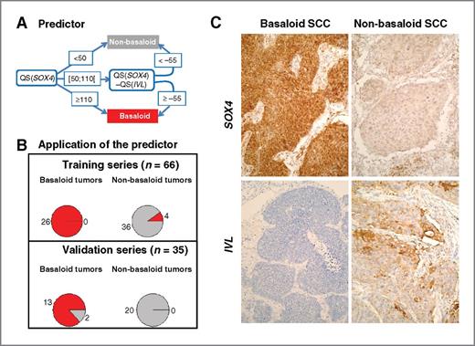 Figure 3. IHC-based predictor of the basaloid entity. A, to discriminate basaloid from non-basaloid tumors, the following predictor is used, based on the QS values of SOX4 and IVL: if QS(SOX4) ≥ 110 then Basaloid; if QS(SOX4) < 50 then Non-basaloid; if QS(SOX4) in [50;110[ and QS(SOX4) − QS(IVL) ≥ − 55 then Basaloid else Non-basaloid. B, pie charts showing the results obtained (red, predicted basaloid; gray, predicted non-basaloid) when applying this predictor to the tumors from the training series (top part) and the validation series (bottom part), in basaloid (left) and non-basaloid (right) tumors. C, illustration of the immunohistochemical measures of SOX4 (top part) and IVL (bottom part) in a basaloid (left part) and a non-basaloid SCC (right part) tumor.