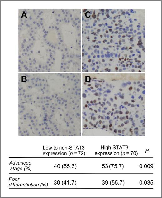 Figure 6. Level of P-STAT3 expression in clinical HCC samples. The expression of p-STAT3 in HCC is significantly correlated with disease aggressiveness. Within the 142 clinical HCC tumors, positive p-STAT3 staining was observed in 92 tumor samples. A and B, representative cases showing low p-STAT3 expression within well-differentiated tumors. C and D, representative immunohistochemical patterns of p-STAT3 in clinical HCC tissues. In line with the results of statistical analysis shown below, high expressions of p-STAT3 were significantly associated with poor tumor differentiation (P = 0.009).
