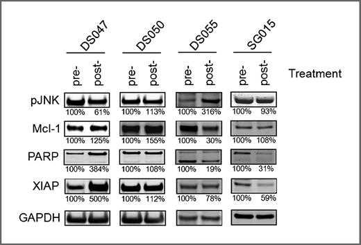 Figure 2. Pharmacodynamic analysis of pretreatment and posttreatment bone marrow samples. CD138+ cells were isolated at baseline (pretreatment) and 24 hours after the first dose of alvocidib and bortezomib treatment (posttreatment). Whole-cell lysates were prepared, electrophoresed on a 4%–12% NuPAGE gel, and Western blotted with primary antibodies to pJNK, Mcl-1, PARP, XIAP, and GAPDH. Following development with an IRDye 680LT-conjugated (LI-COR) secondary antibody, the fluorescent signals were quantitated on an Odyssey Imager. Values below the figures represent the level of assayed proteins determined by densitometric analysis normalized to GAPDH levels, where the normalized level of the pretreatment sample is defined as 100%.