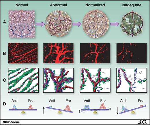 Figure 1. Normalization of tumor vasculature. A, tumor vasculature is structurally and functionally abnormal. One potential mechanism of action for antiangiogenic therapies is transient improvement in both the structure and the function of tumor vessels. However, sustained antiangiogenic treatment may eventually result in a vasculature that is both resistant to further treatment and inadequate for the delivery of drugs or oxygen. B, vessel structural patterns before, during, and with sustained VEGFR2 blockade. C, diagram depicting the concomitant changes in pericyte coverage (green) and basement membrane thickness (blue) before, during, and with sustained VEGFR2 blockage. D, changes in the balance of pro- and antiangiogenic factors leading to the phenotypic changes noted above. Reprinted from Jain (98).