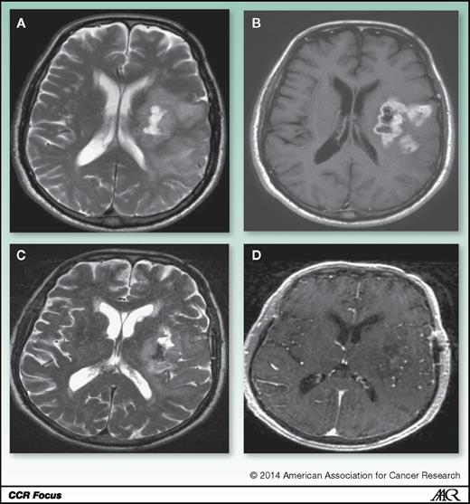 Figure 2. Pseudoresponse: a patient treated with bevacizumab. Within 6 days of treatment there is a dramatic decrease in contrast enhancement, but the T2 abnormality remains. A, pretreatment T2 image. B, pretreatment after-contrast image. C, T2 image 6 days after bevacizumab. D, after-contrast image 6 days after bevacizumab.