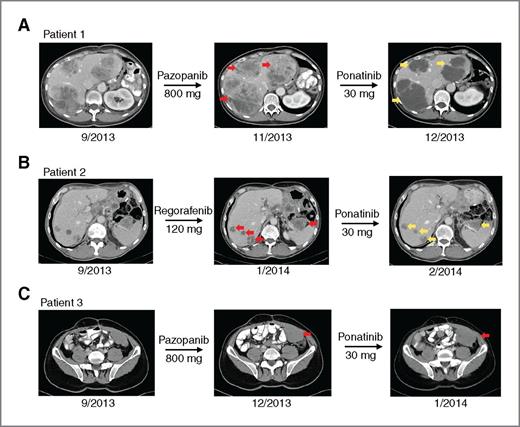 Figure 5. Single-agent ponatinib is active in heavily pretreated patients with TKI-resistant GIST. Representative CT scans of 3 patients with KIT exon 11-mutant GIST before and after treatment with 30-mg ponatinib for 4 weeks. Each patient was heavily pretreated with imatinib, sunitinib, and regorafenib. A, patient 1: ponatinib induced regression and cyst-like transformation of multiple metastatic lesions. B, patient 2: ponatinib induced moderate responses in multiple lesions. C, patient 3: no response to ponatinib treatment. Red arrows highlight areas of tumor growth, whereas yellow arrows indicate tumor response.