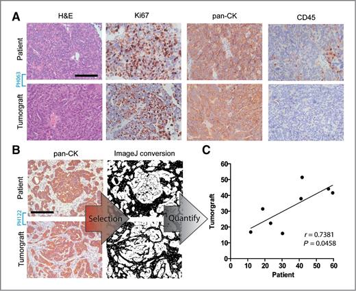 Figure 2. Histologic similarities between patients and corresponding tumorgrafts. A, representative hematoxylin and eosin (H&E), Ki67, pan-cytokeratin (pan-CK), and CD45 expression in tumorgraft model PH063 shows conserved morphology, proliferation index by Ki67, and epithelial phenotype by pan-cytokeratin (40×). Scale bar, 100 μm. B, cytokeratin staining in tumorgraft and source patient pathology sections (PH122 shown) were selected and quantified using the ImageJ software as described in Materials and Methods (20×). Scale bar, 200 μm. C, the calculated nonepithelial tissue for eight tumorgraft models was plotted against that of the source patient.
