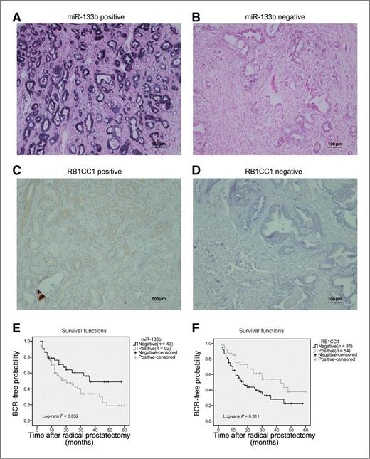 Figure 5. miR-133b and RB1CC1 as potential prognostic markers for prostate cancer. A to D, miR-133b and RB1CC1 expression in prostate cancer samples. A, the representative positive expression of miR-133b was mainly detected in prostatic epithelial cells. B, the representative negative staining of miR-133b in prostatic epithelial cells. C, the representative positive staining of RB1CC1 on tissue arrays. D, RB1CC1 staining was negative in prostate cancer samples. The magnification is 100×. E and F, the Kaplan–Meier analysis showed BCR-free survival of patients with prostate cancer patients. E, miR-133b. F, RB1CC1.