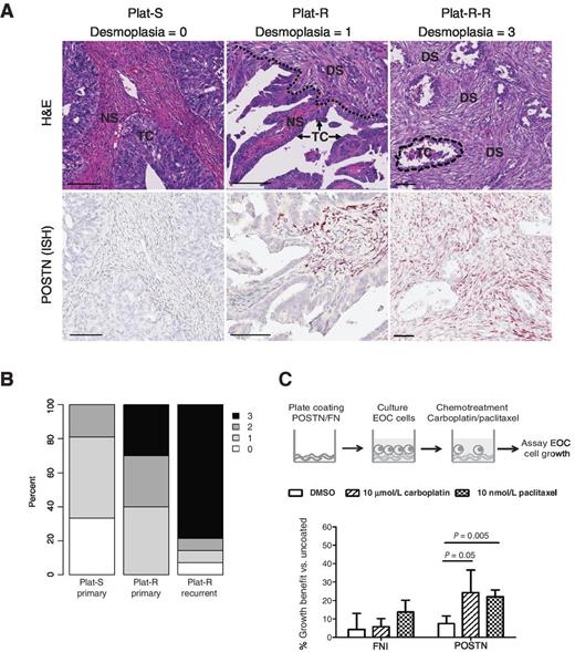 Figure 3. POSTN correlates desmoplasia phenotype in vivo and promotes chemoresistance in EOC cells in vitro. A, increased desmoplasia is correlated with POSTN expression and primary chemoresistance. Representative high magnification images of H&E staining for tumor specimens (top) and POSTN ISH images (bottom) are shown. Desmoplasia scores were defined as follows: 0, no desmoplasia; 1, few scattered desmoplastic foci abutting cancer cells; 2, several desmoplastic foci abutting cancer cells or moderate confluent (wider) desmoplasia, but not present throughout the section; 3, desmoplastic reaction throughout section, associated with most cancer cells. DS, desmoplastic stroma; NS, normal stroma; TC, tumor cells. Arrows, examples of tumor cells. Dotted line encircles a region containing tumor cells. Size bars, 100 μm. B, summary of desmoplasia scores in 21 Plat-S primary, 18 Plat-R primary, and 21 Plat-R recurrent tumor specimens. C, POSTN promotes chemoresistance in chemosensitive ES-2 ovarian cells in vitro. Ninety-six-well plates were coated with recombinant protein FN1 or POSTN or left uncoated before cells were plated into each well. Then, 10 μmol/L carboplatin or 10 nmol/L Taxol was added to each well on the next day. CellTiter-Glo reagents were added at 72 hours after compound treatment to measure cell viability. The viability in coated wells was then compared with the one in uncoated wells to calculate percentage growth benefit.