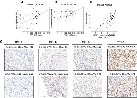 Figure 1. Robust quantification of TTF1/NKX2-1 in clinical samples. TTF1 as measured by IHC (the gold standard) and by RPPA correlate well in the PROSPECT cohort (n = 93; A). NKX2-1 mRNA expression and TTF1 IHC scores also correlate well across a larger PROSPECT cohort (n = 152; B) for which both gene expression and IHC data were available. Representative images of 0, 1+, 2+, and 3+ TTF1 IHC stating correlate well with IHC, RPPA, and mRNA scores (C). By way of cross-validation, NKX2-1 gene expression and TTF1 RPPA also correlated well (D, n = 93).