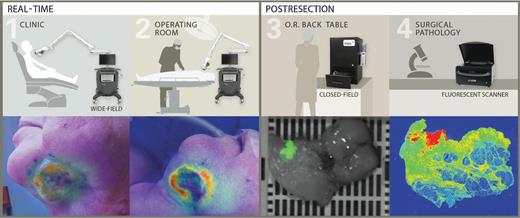 Figure 1. Trial imaging workflow. Real-time imaging was performed with a wide-field NIR imaging system in the clinic on (1) days 0, 1, and in the (2) operating room on day 3 after cetuximab-IRDye800 infusion. 3, during postresection processing, resected tissues were imaged with a closed-field NIR imaging system. 4, following histologic preparation, a corresponding slide was imaged in surgical pathology using a fluorescence scanning system.