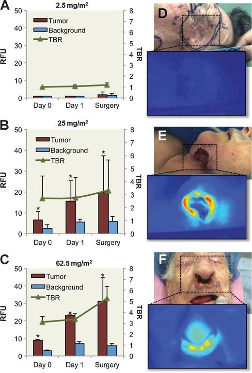 Figure 2. Quantification of wide-field fluorescence imaging. RFUs acquired during wide-field fluorescent imaging of tumor, background, and TBR are shown for (A) 2.5 mg/m2 cohort, (B) 25 mg/m2 cohort, and (C) 62.5 mg/m2 cohort. White light and fluorescence images acquired using wide-field imaging device are shown for (D) 2.5 mg/m2 cohort, (E) 25 mg/m2 cohort, and (F) 62.5 mg/m2 cohort. Asterisk denotes significant (P < 0.05) increase in tumor RFU compared with background for respective day. Data are RFU and TBR ± SD.