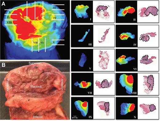 Figure 4. Correlation of fluorescence and disease margin. Wide-field fluorescence (A) and brightfield (B) image are shown of resected primary tumor. Gridlines represent whole tissue (4–5 mm) sections cut during pathologic processing of specimen. Breadloaf sections were fluorescently imaged using closed-field imaging device, then formalin-fixed, sectioned, and H&E stained. Black outline represents tumor deposition as determined by board-certified pathologist. Fluorescent images of whole tissue sections and corresponding H&E-stained sections are oriented with mucosal side at top.