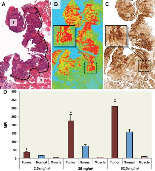Figure 6. Histopathology and fluorescence localization. A, representative H&E image of tumor sections from the 25 mg/m2 dose group. Pathology-positive areas of cancer are outlined: T, tumor; N, normal adjacent tissue. B, fluorescence image of fixed, unstained tumor section shown in A acquired using fluorescent scanner with inset-magnified area of pathology-positive cancer and (C) EGFR stain. D, MFI acquired using fluorescent scanning of fixed unstained tissue sections is shown for tumor, normal adjacent, and muscle. Data are average MFI ± SE. Asterisk denotes significant (P < 0.001) increase in tumor MFI compared with normal and muscle for respective dose.