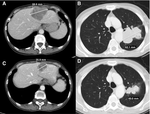 Figure 3. Example responder: KRAS-mutant adenocarcinoma of lung. A 63-year-old female never smoker of Asian ethnicity with metastatic adenocarcinoma of the lung, which was KRAS G12D mutant, but wild-type for EGFR, anaplastic lymphoma kinase (ALK), PIK3CA, and BRAF gene aberrations. A and B represent pretreatment scans, whereas C and D represent the same slices of scans with best response to the treatment. This patient's prior treatments included (i) cisplatin and pemetrexed (2 cycles with disease progression); (ii) carboplatin and paclitaxel (8 cycles with partial response); (iii) docetaxel (2 cycles with disease progression); (iv) carboplatin and paclitaxel rechallenge (2 cycles with disease progression); (v) radiotherapy to spine metastases. She was treated with MK-2206 135 mg PO once weekly and selumetinib 100 mg PO once daily without dose reduction, although she had a grade 2 skin rash that was tolerable. She had a RECIST partial response with 45% reduction in the sum of diameters of the target lesions. The patient eventually developed progressive disease after 6 cycles due to the development of symptomatic brain metastases.