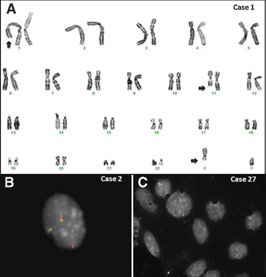 Figure 2. A, representative karyotype of case 1 showing a translocation t(X;1;11)(q13;p36;q23) correlating with the genomic location of the MED12 and PRDM10 genes. B and C, interphase FISH analysis revealing split signals with BAC probes covering 5′and 3′ regions neighboring the PRDM10 gene.