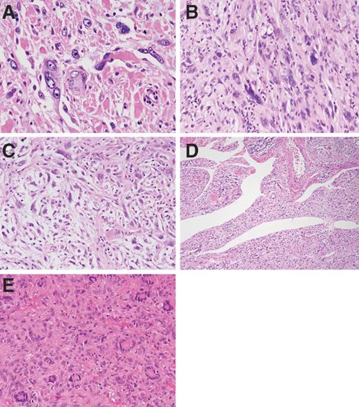 Figure 3. Morphology of PRDM10 fusion-positive UPS. A, case 2 showing nondistinctive pleomorphic spindle and ovoid cells. B, high power of case 1 highlights bizarre nuclear morphology. C to E, individual cases showing focally myxoid stroma (case 2), pseudovascular clefts (case 1), and prominent tumor giant cells (case 27).