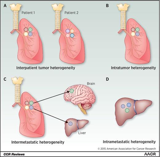 Figure 1. Different types of tumor heterogeneity. A, intratumor heterogeneity: the presence of multiple subclones within a primary tumor resulting in heterogeneity among tumor cells. B, interpatient heterogeneity: the presence of unique subclones in the tumor of each patient. C, intermetastatic heterogeneity: the presence of different subclones in different metastatic lesions of the same patient; some subclones may have been derived from the primary tumor and some may have emerged as a result of acquired alterations within each metastatic lesion. D, intrametastatic heterogeneity: the presence of multiple subclones within a single metastatic lesion.