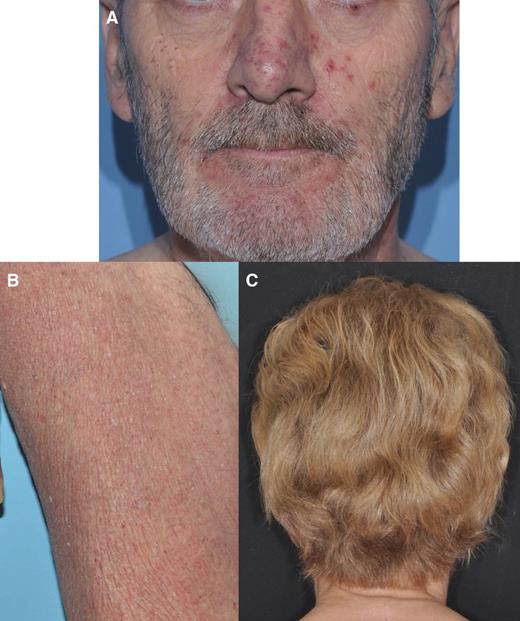 Figure 1. Representative photographs of dermatologic adverse events showing acneiform rash (A), dry skin (B), and cymotrichous (C).