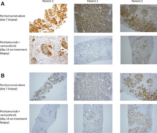 Figure 2. Representative sections from IHC analysis of phosphorylated ERK (A) and cyclin D1 expression (B). Samples collected before vemurafenib treatment, after 1 week of panitumumab therapy, are on the top row, and samples collected after 2 weeks of combined panitumumab and vemurafenib treatment are on the bottom row.