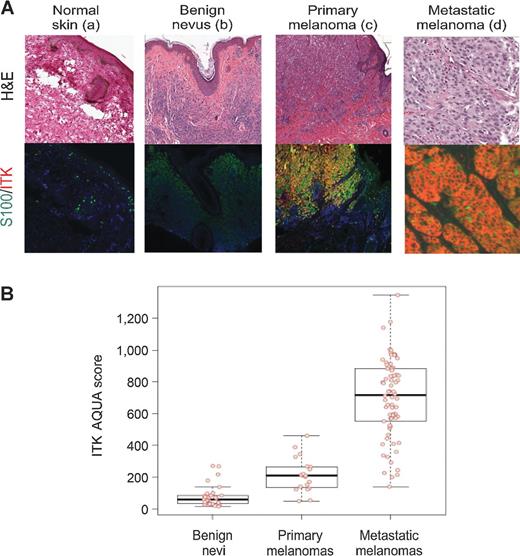 Figure 1. ITK expression in melanocytic tissues. A, representative tissue sections from normal skin (a), benign nevus (b), primary melanoma (c), and metastatic melanoma (d) were stained with H&E (top row) or probed with ITK-Cy5 (red) and S100-Alexa 555 (green) primary and secondary antibodies and counterstained with DAPI (blue). Orange indicates colocation of ITK with S100, a melanocytic lineage marker. The clinical and histologic characteristics of the melanocytic tissues stained and their ITK levels are in Supplementary Table S1. Staining protocols are in Supplementary Table S2. B, box-and-whisker plots (median with the 25–75th percentiles and outliers) of ITK expression in S100+ cells from nevi (n = 30), primary melanomas (n = 20), and metastatic melanomas (n = 70). Of the metastatic melanomas, 91% (64/70) had ITK expression above that of the range of ITK expression found in nevi.