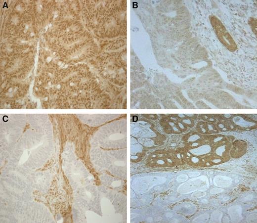 Figure 1. Patterns of SMAD4 expression: A, strong expression; B, weak expression; C, complete loss (note positive stromal cells); and D, clonal loss. Immunoperoxidase, ×200.