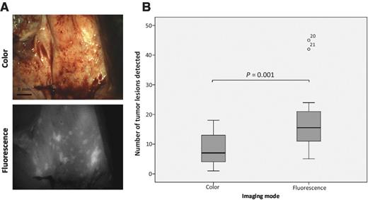 Figure 2. Visual detection of tumor deposits ex vivo. A, representative color (top) and fluorescence (bottom) images used to quantify the visual detection of tumor deposits. B, box plot summarizing the number of tumor lesions detected based on the matched color and fluorescence images.