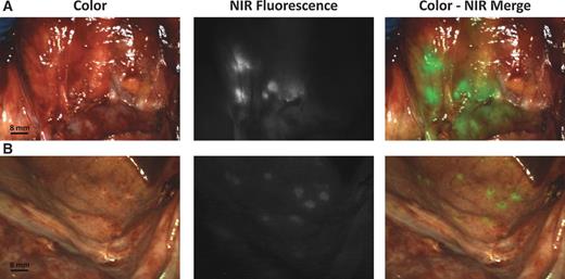 Figure 3. Intraoperative detection of ovarian cancer metastases using fluorescence-based imaging. A and B, color (left column), fluorescence (middle column), and merged (right column) images of retroperitoneal lymph nodes containing metastases of ovarian cancer (A) and superficial peritoneal metastases of ovarian cancer (B).