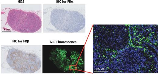 Figure 4. Histopathologic evaluation and fluorescence signal of a false positive lymph node. The images show a fluorescent lymph node (bottom right) that did not contain ovarian cancer metastases on hematoxylin and eosin (H&E) staining (top left) and was negative for FRα immunostaining (top right). Immunostaining for FRβ showed positive staining in the sinuses, but not in the follicles (bottom left). The magnified image at the right shows that the fluorescence pattern was localized to the sinuses, consistent with FRβ staining.