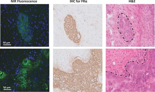 Figure 5. Histopathologic evaluation and fluorescence signal in ovarian cancer. Representative samples from two different patients. Fluorescence microscopy (left column) shows clear membranous and cytoplasmic accumulation of OTL38 in tumor cells. The fluorescence signal is indicated in green, and the nuclei were counterstained with DAPI (blue). The fluorescence pattern is consistent with FRα expression measured using IHC (middle column), which corresponds to the anatomical site containing a serous ovarian adenocarcinoma metastasis visible on hematoxylin and eosin (H&E) staining (right column, dashed outline).